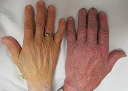 260px-Anemia - Saffron4health