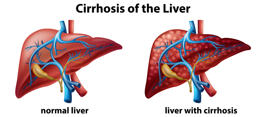 liver cirrhosis - Saffron4health
