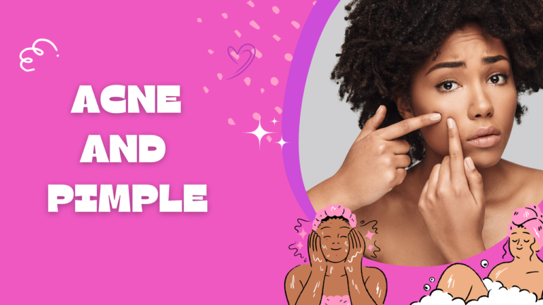 Acne and Pimple